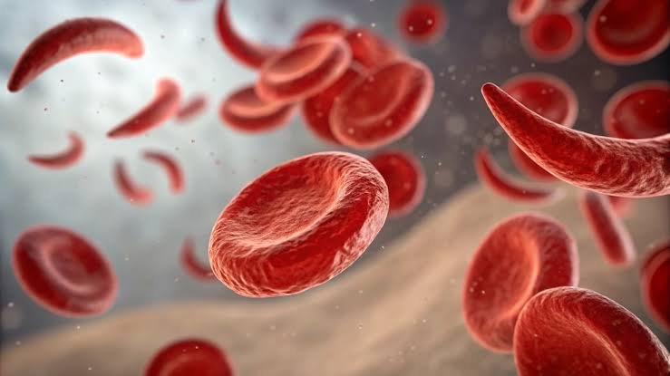 Sickle cell detection